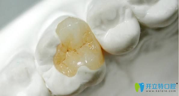 補(bǔ)牙的另一種方法——嵌體