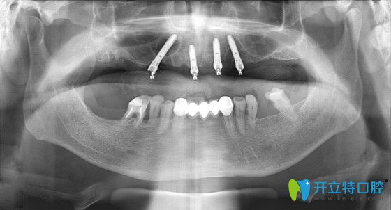 張大爺在東營鉑爾口腔做種植牙后的CT片 張大爺在東營鉑爾口腔做種植牙后的CT片