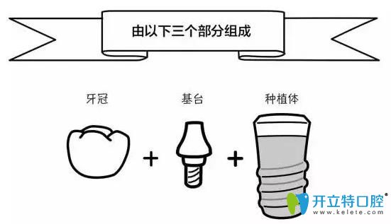 種植牙的組成部分