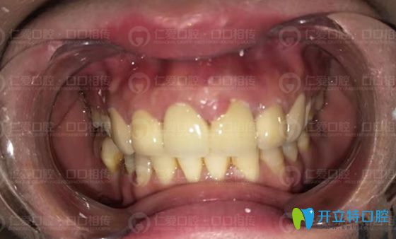 <!--<i data=20240703-sp></i>-->口腔對烤瓷牙失敗的修復(fù)效果