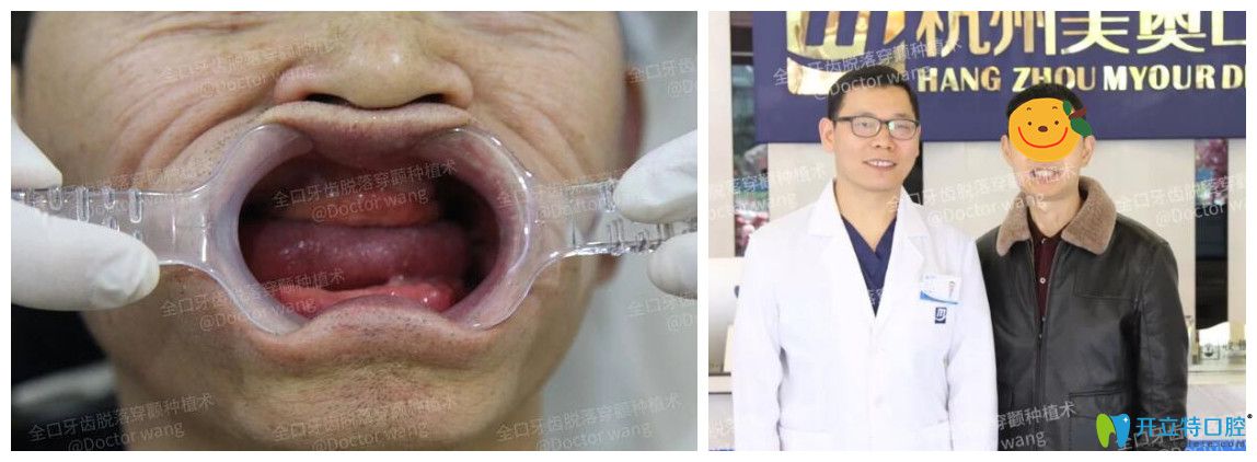 黃先生全口牙齒缺失在美奧做了穿顴種植真實案例分享