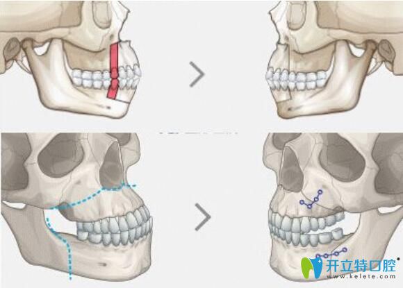 凸嘴正頜手術(shù)