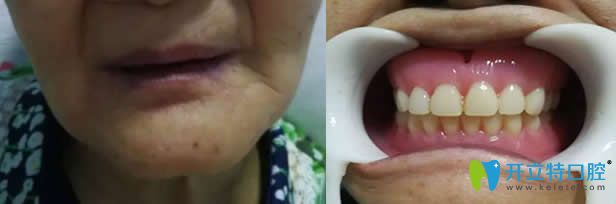 李阿姨在東營(yíng)鉑爾口腔做吸附性義齒前后照片