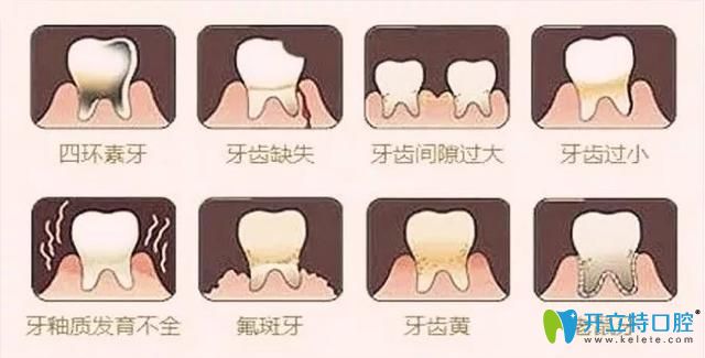 牙齒貼面適合人群 牙齒貼面適合人群