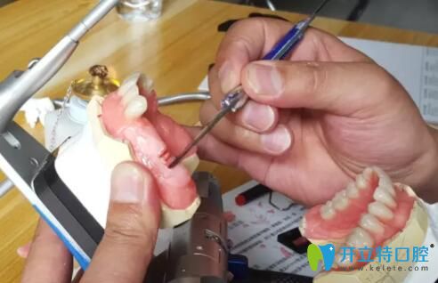 全口假牙制作過程