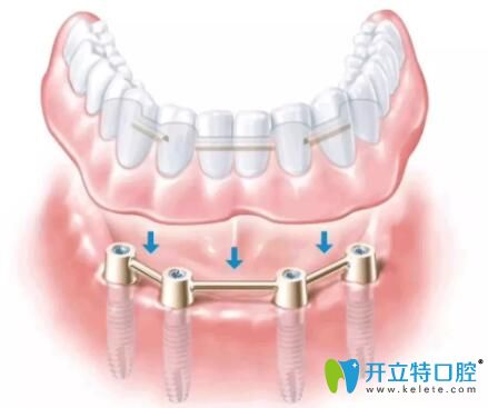 All-on-4半口種植