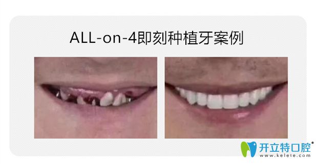 All-on-4即刻種植牙對比圖片