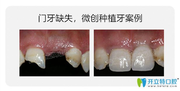 河山口腔微創(chuàng)種植牙案例對比圖