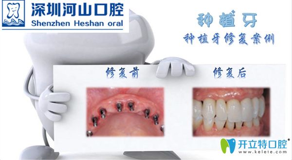 搞到了深圳世紀(jì)河山口腔全口/多顆種植牙成功案例對比圖片