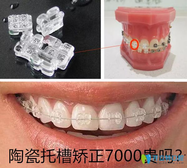 陶瓷托槽半隱形矯正圖片