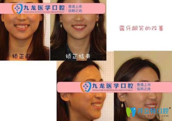 珠海九龍口腔牙齒矯正<span style=
