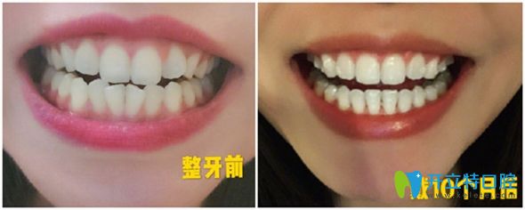 時代天使隱形矯正10個月前后效果圖 時代天使隱形矯正10個月前后效果圖