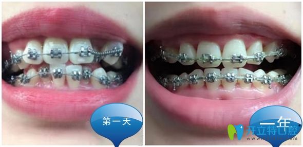 金屬自鎖托槽矯正1年前后效果圖 金屬自鎖托槽矯正1年前后效果圖