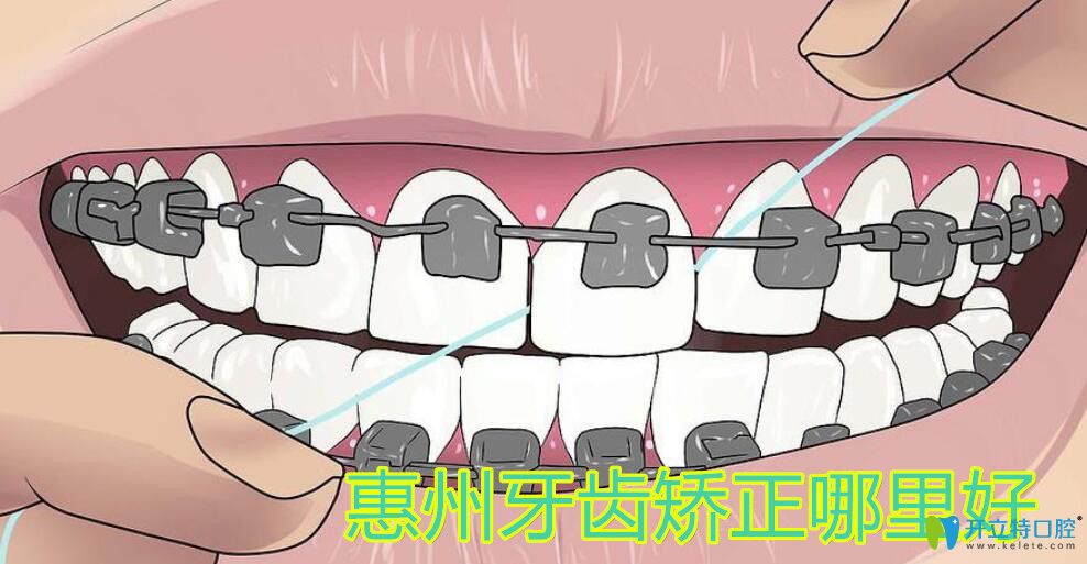 惠州哪里矯正牙齒好
