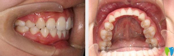 成都圣貝牙科正畸如何？附網(wǎng)友整牙的感受及圣貝箍牙價格