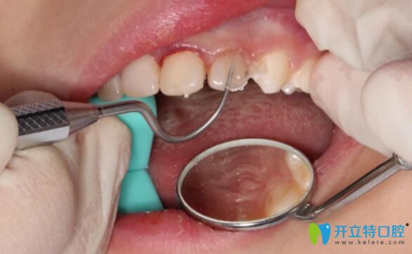 透明預成冠充填樹脂