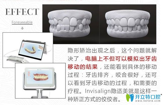 國(guó)產(chǎn)隱形牙套和進(jìn)口的區(qū)別是什么