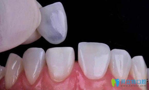 全瓷牙貼面修復效果圖