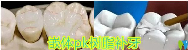 傳統(tǒng)補(bǔ)牙PK 嵌體修復(fù)