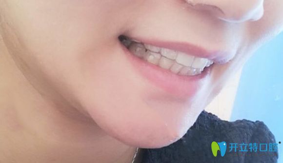 在北京美萊口腔戴隱形牙套18個月的矯正效果圖