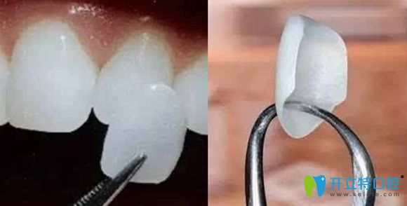 牙齒貼面多少錢一顆的價格展示