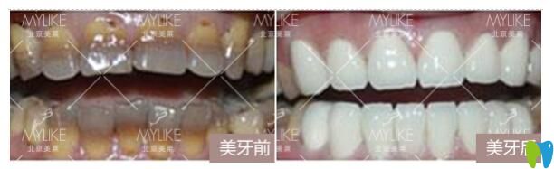 北京美萊口腔牙齒貼面前后對(duì)比圖