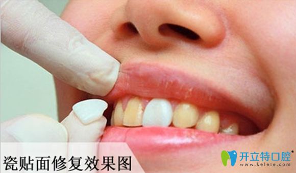 牙齒貼面修復效果圖