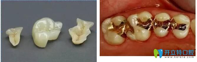 補(bǔ)牙嵌體