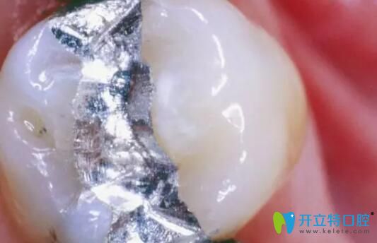 銀汞合金補(bǔ)牙