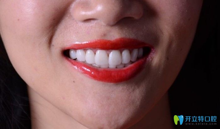 美萊口腔牙齒貼面效果圖