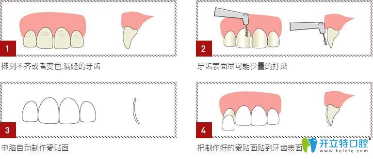牙齒貼面步驟圖解