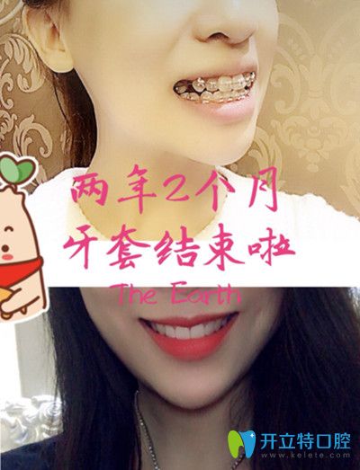 金屬托槽矯正前后變化圖