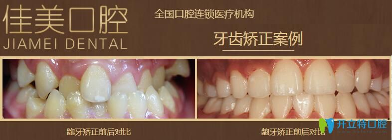 北京佳美口腔齙牙矯正案例圖
