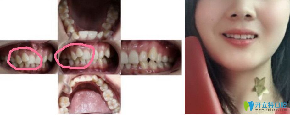 虎牙在伊爾意矯正前后對比照