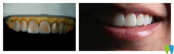 珍瑞白瓷貼面剛貼時(shí)和調(diào)色后的效果對(duì)比