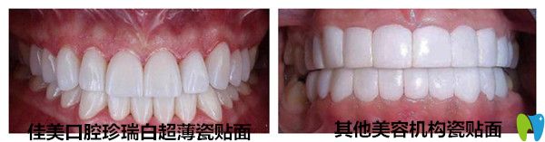 珍瑞白瓷貼面與其他機(jī)構(gòu)瓷貼面對(duì)比