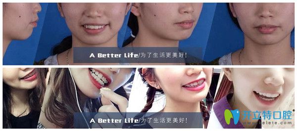 南寧柏樂口腔矯正案例