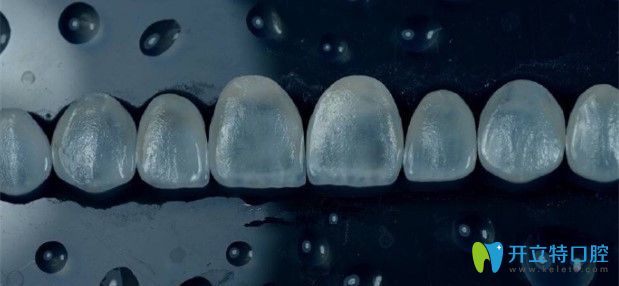 佳美口腔珍瑞白超薄瓷貼面