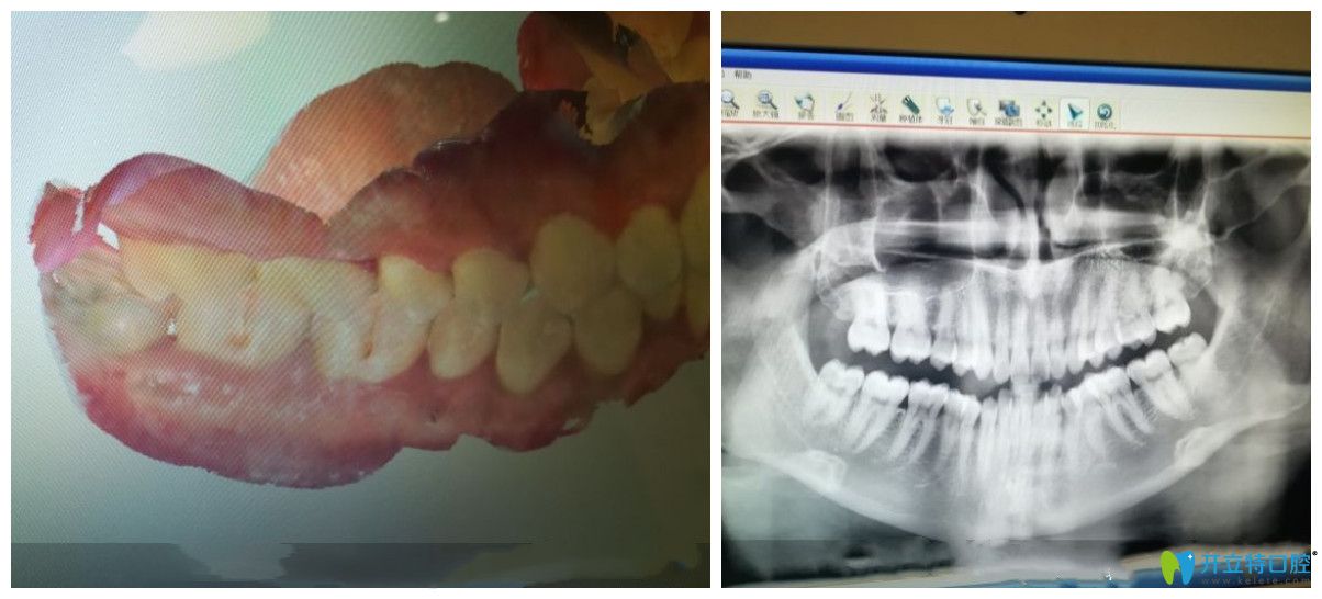 在成都圣貝口腔做隱形矯正前檢查圖