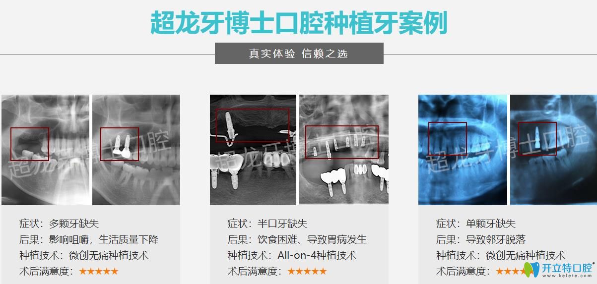 長春超龍牙博士口腔種植牙案例 長春超龍牙博士口腔種植牙案例