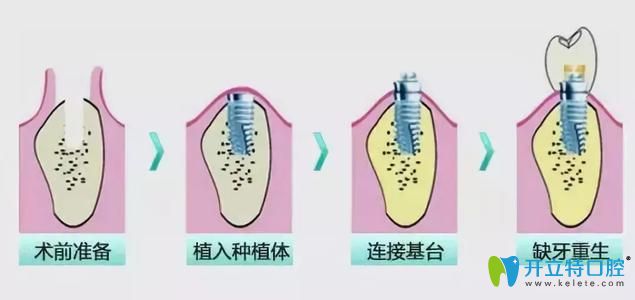 傳統(tǒng)種植牙過程