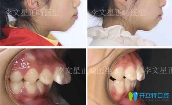 成都茁悅口腔兒牙矯正前后效果