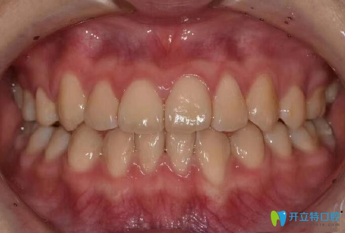 地包天在重慶茁悅口腔做隱適美牙齒矯正后