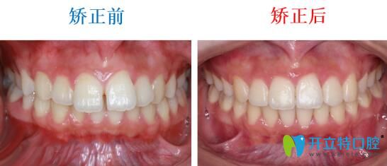 在武漢壹加壹口腔做齙牙矯正前后對比照