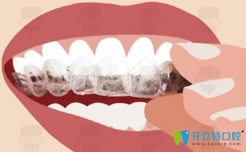 武漢壹加壹口腔隱適美牙齒矯正