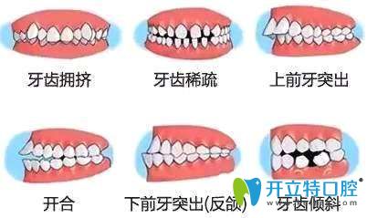 牙齒不齊情況