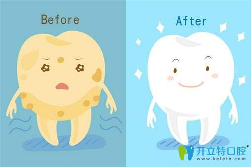 牙齒美白前后對(duì)比示意圖 牙齒美白前后對(duì)比示意圖