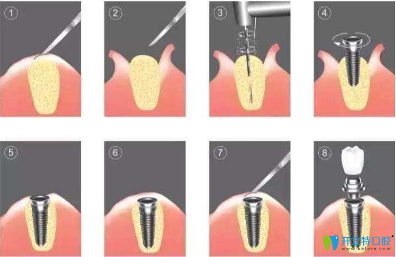 想知道種植牙微創(chuàng)和普通區(qū)別,先了解下不開瓣3d導(dǎo)板種植牙