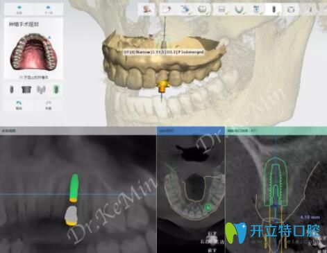 數(shù)字化3d導(dǎo)板種植牙