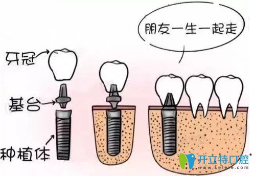 種植牙閃亮登場